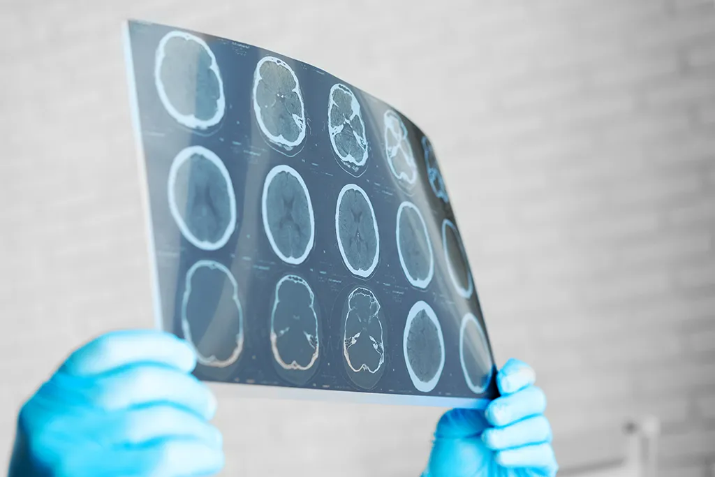 Brain scan showing regions affected by Parkinson's Disease.